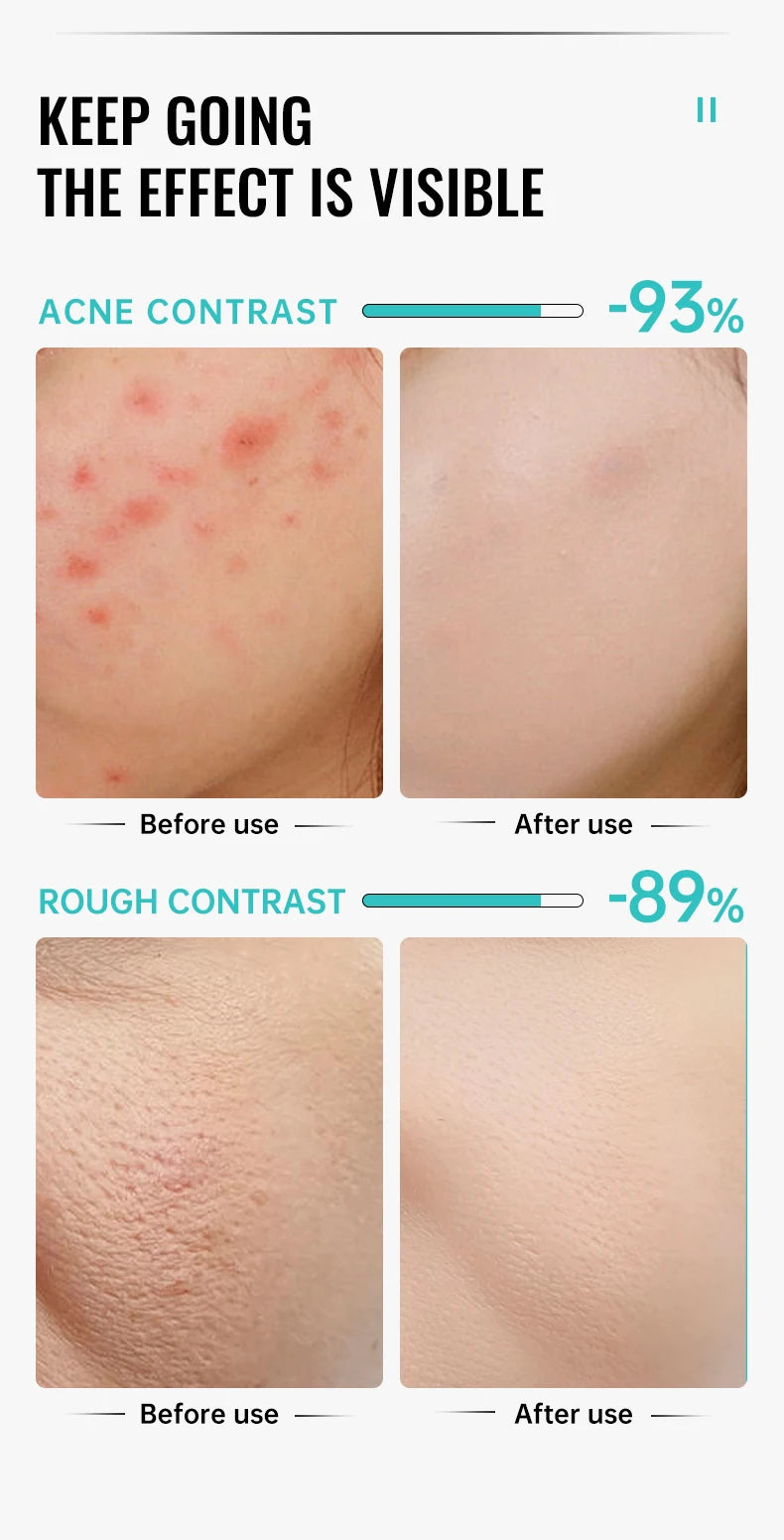 Salicylic Acid Acne Reduce Face Cream Faded Pimple Spots Deep Cleaning Pore Acne Scar Oil Control Moisturizing Skincare Product