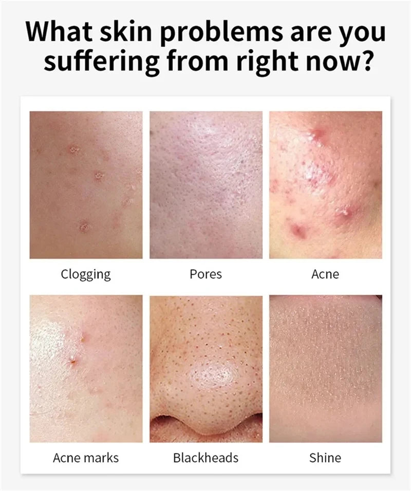 Salicylic Acid Acne Reduce Face Cream Faded Pimple Spots Deep Cleaning Pore Acne Scar Oil Control Moisturizing Skincare Product