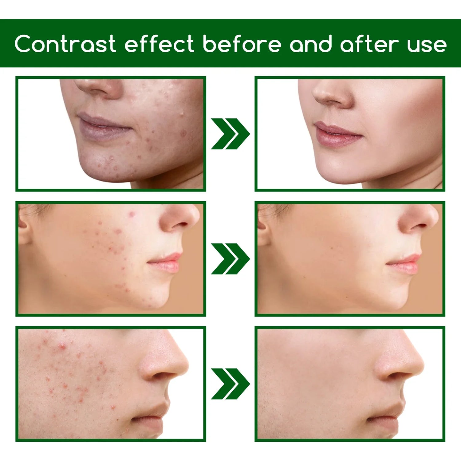Acne Solutions