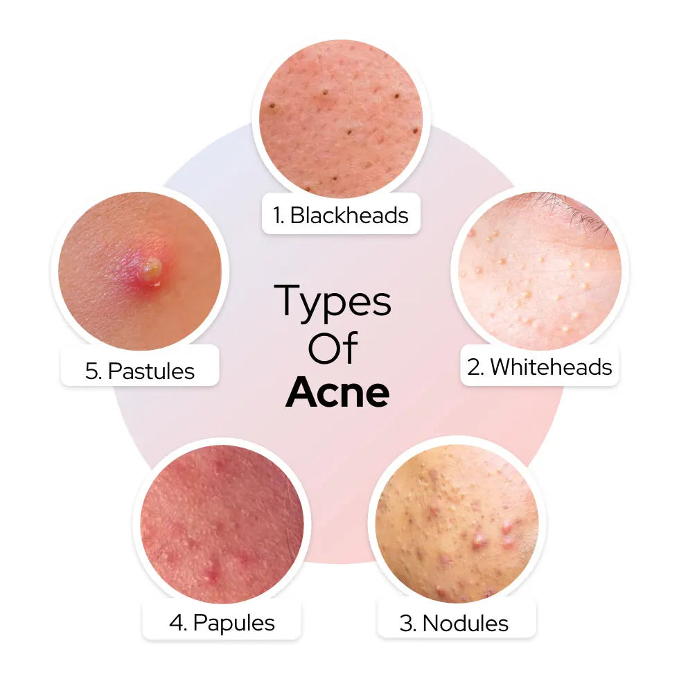 Salicylic Acid Acne Reduce Face Cream Faded Pimple Spots Deep Cleaning Pore Acne Scar Oil Control Moisturizing Skincare Product